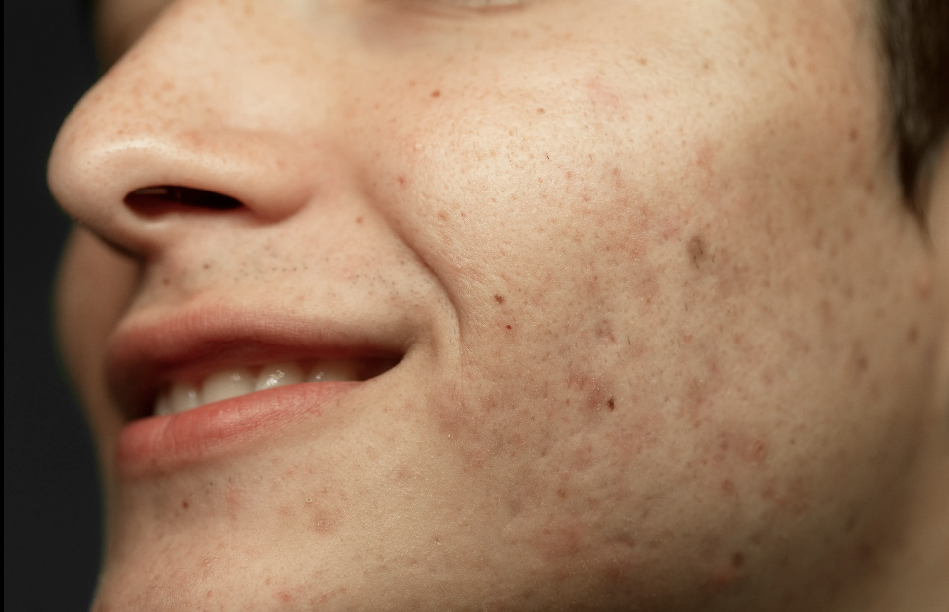 “جانب الوجه ببشرة فاتحة مع آثار تصبغ خفيفة–متوسطة على الخد (Post-inflammatory hyperpigmentation).”